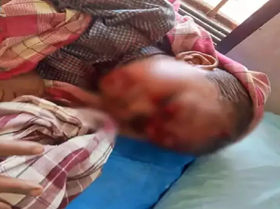 CG : 4 साल के मासूम पर आवारा कुत्ते का हमला, सिर-मुंह समेत 17 जगह गंभीर जख्म …